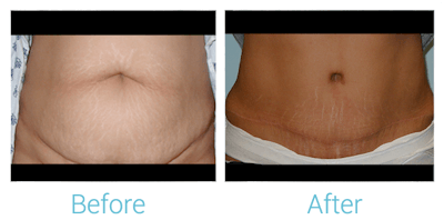 Tummy Tuck Before & After Gallery - Patient 58152063 - Image 1