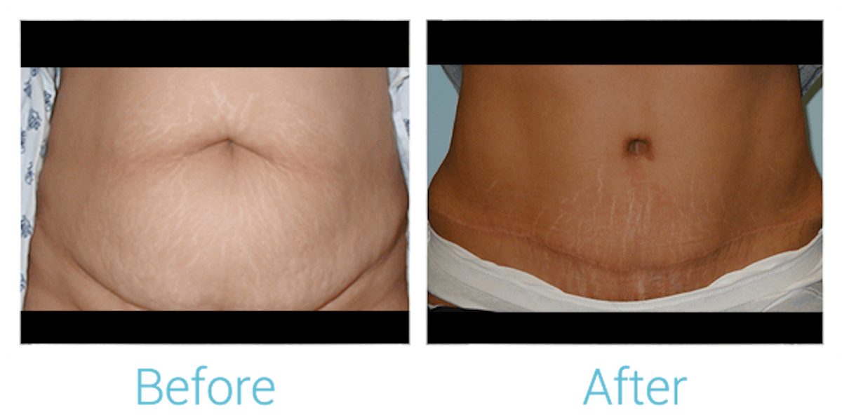 Tummy Tuck Before & After Gallery - Patient 58152063 - Image 1