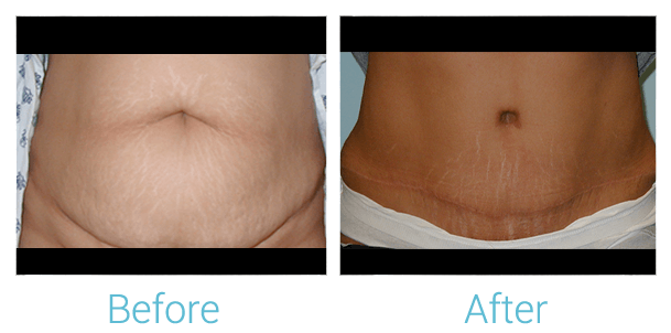 Tummy Tuck Before & After Gallery - Patient 58152063 - Image 1