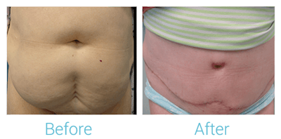 Tummy Tuck Before & After Gallery - Patient 58152064 - Image 1