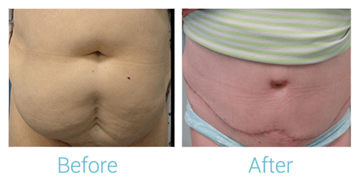 Tummy Tuck Before & After Gallery - Patient 58152064 - Image 1
