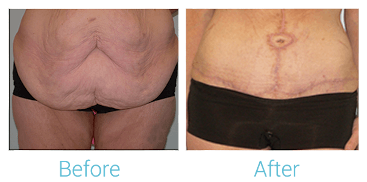 Tummy Tuck Before & After Gallery - Patient 58152065 - Image 1