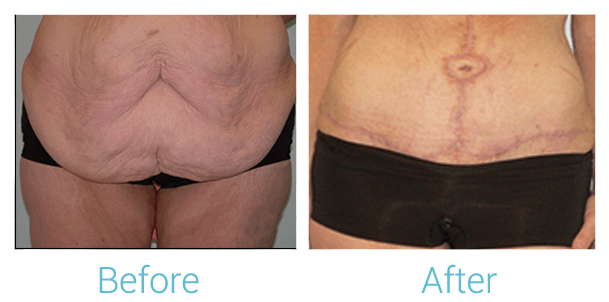 Tummy Tuck Before & After Gallery - Patient 58152065 - Image 1