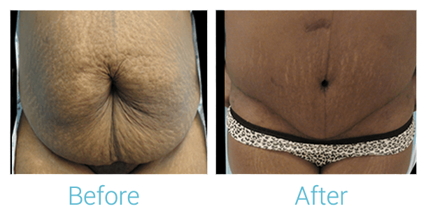 Tummy Tuck Before & After Gallery - Patient 58152073 - Image 1