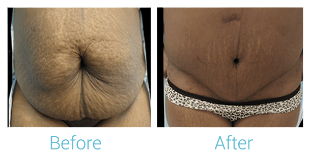 Tummy Tuck Gallery - Patient 58152073 - Image 1