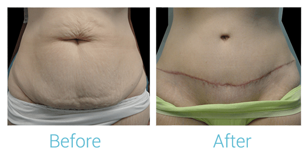 Tummy Tuck Before & After Gallery - Patient 58152074 - Image 1