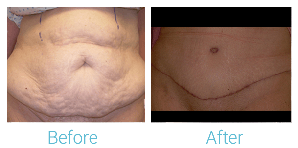 Tummy Tuck Before & After Gallery - Patient 58152075 - Image 1