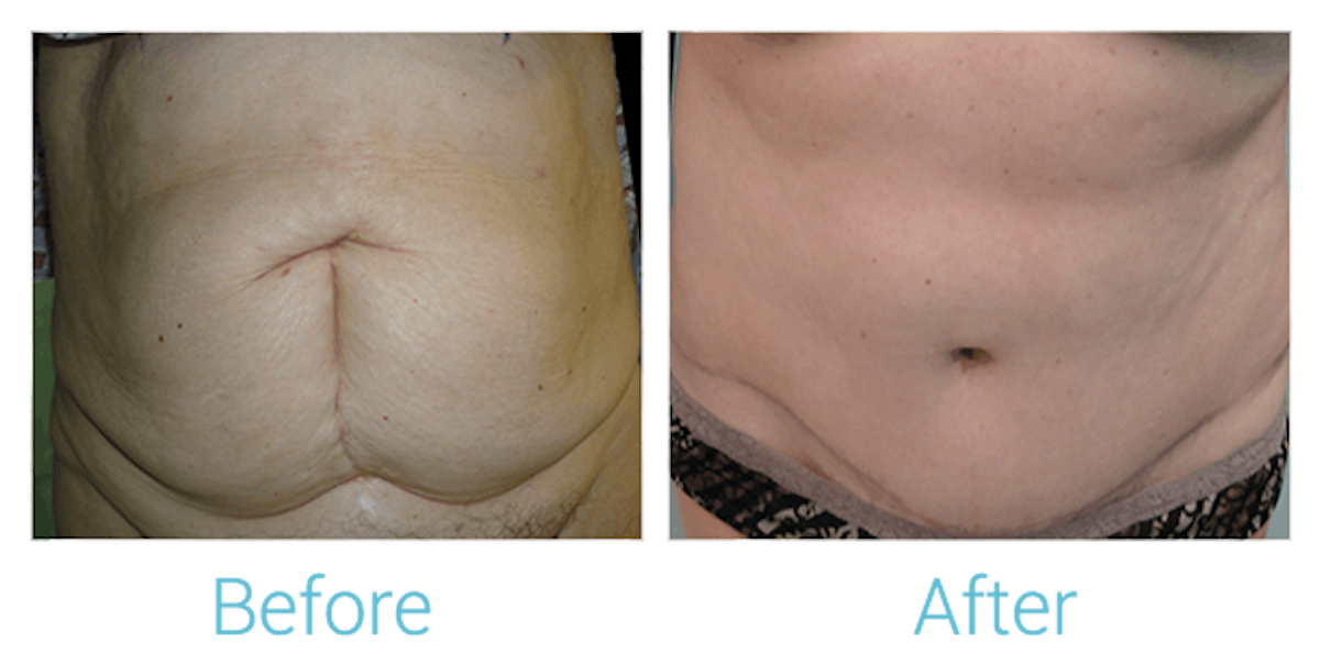 Tummy Tuck Before & After Gallery - Patient 58152076 - Image 1