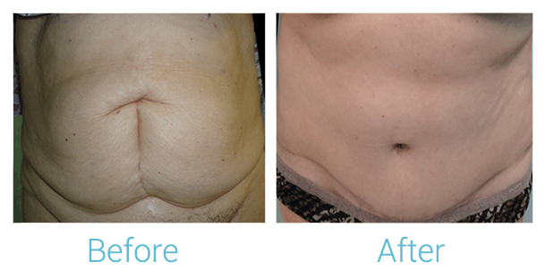 Tummy Tuck Before & After Gallery - Patient 58152076 - Image 1