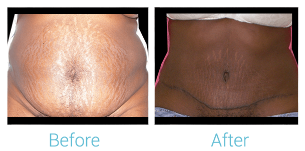 Tummy Tuck Gallery - Patient 58152078 - Image 1