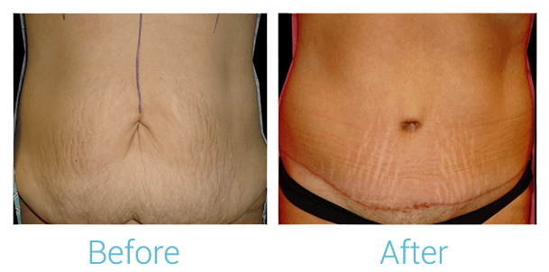 Tummy Tuck Before & After Gallery - Patient 58152079 - Image 1