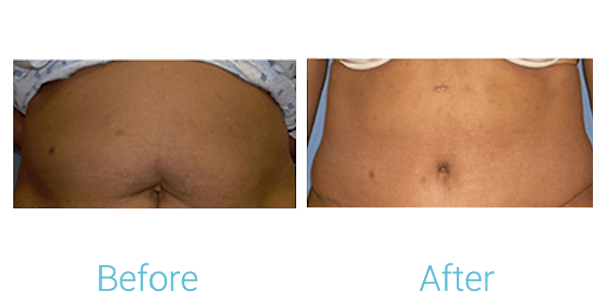 Tummy Tuck Before & After Gallery - Patient 58152080 - Image 1