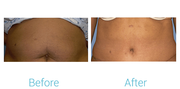 Tummy Tuck Before & After Gallery - Patient 58152080 - Image 1