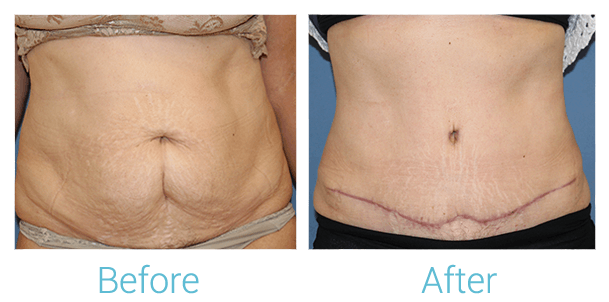Tummy Tuck Before & After Gallery - Patient 58152081 - Image 1