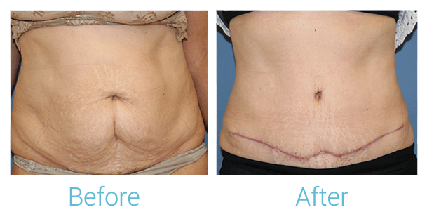 Tummy Tuck Gallery - Patient 58152081 - Image 1