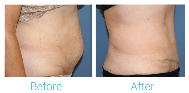 Tummy Tuck Gallery - Patient 58152081 - Image 2