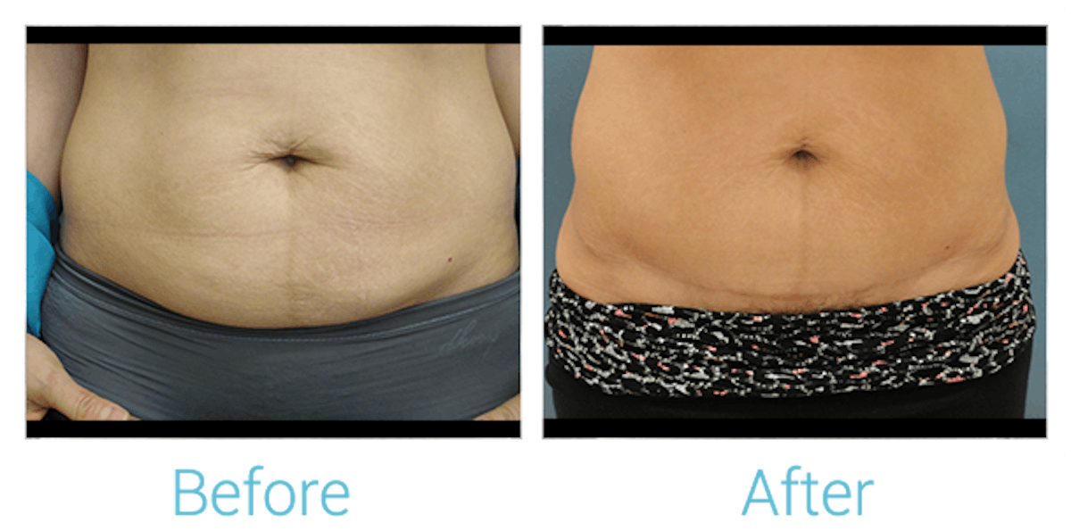 Tummy Tuck Before & After Gallery - Patient 58152082 - Image 1