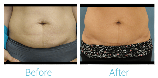 Tummy Tuck Before & After Gallery - Patient 58152082 - Image 1