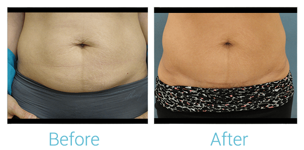 Tummy Tuck Gallery - Patient 58152082 - Image 1