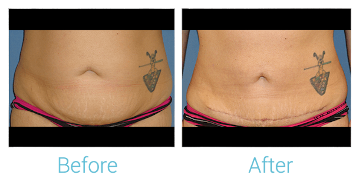 Tummy Tuck Before & After Gallery - Patient 58152083 - Image 1