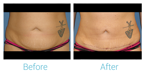 Tummy Tuck Before & After Gallery - Patient 58152083 - Image 1