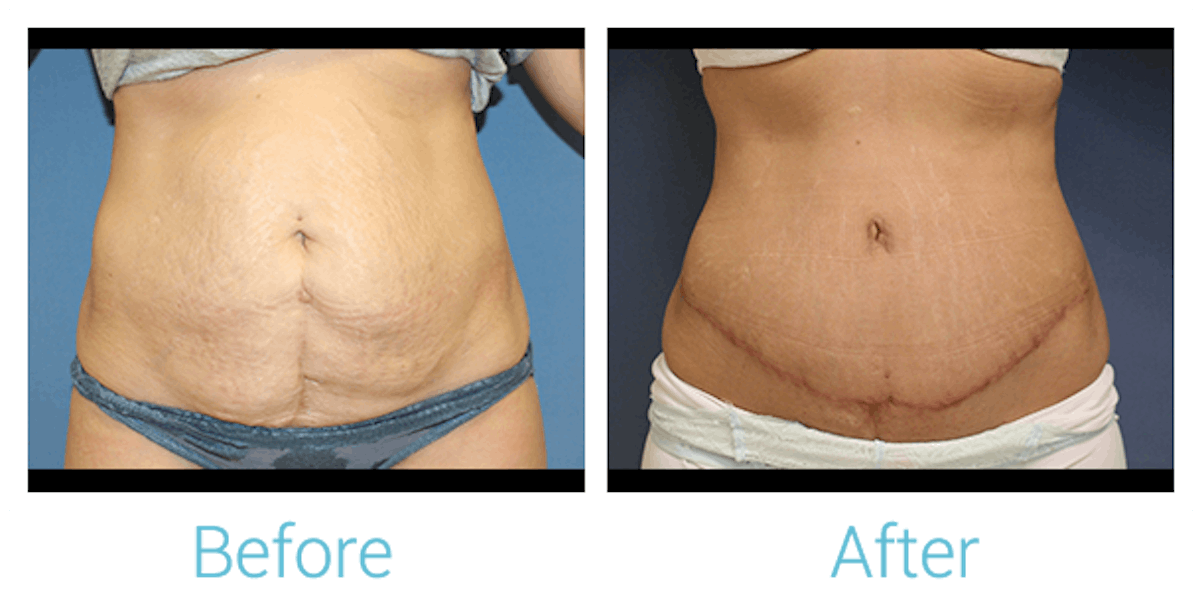 Tummy Tuck Before & After Gallery - Patient 58152084 - Image 1