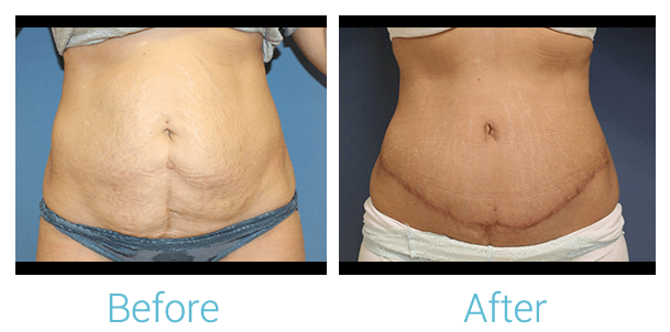 Tummy Tuck Before & After Gallery - Patient 58152084 - Image 1