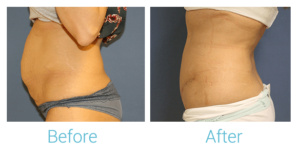 Tummy Tuck Before & After Gallery - Patient 58152085 - Image 1