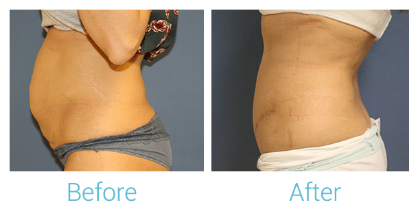 Tummy Tuck Gallery - Patient 58152085 - Image 1