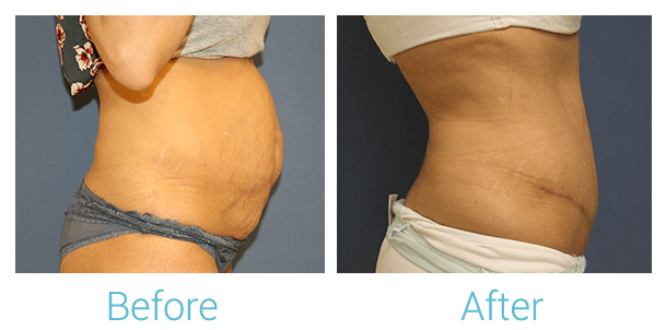 Tummy Tuck Before & After Gallery - Patient 58152085 - Image 2