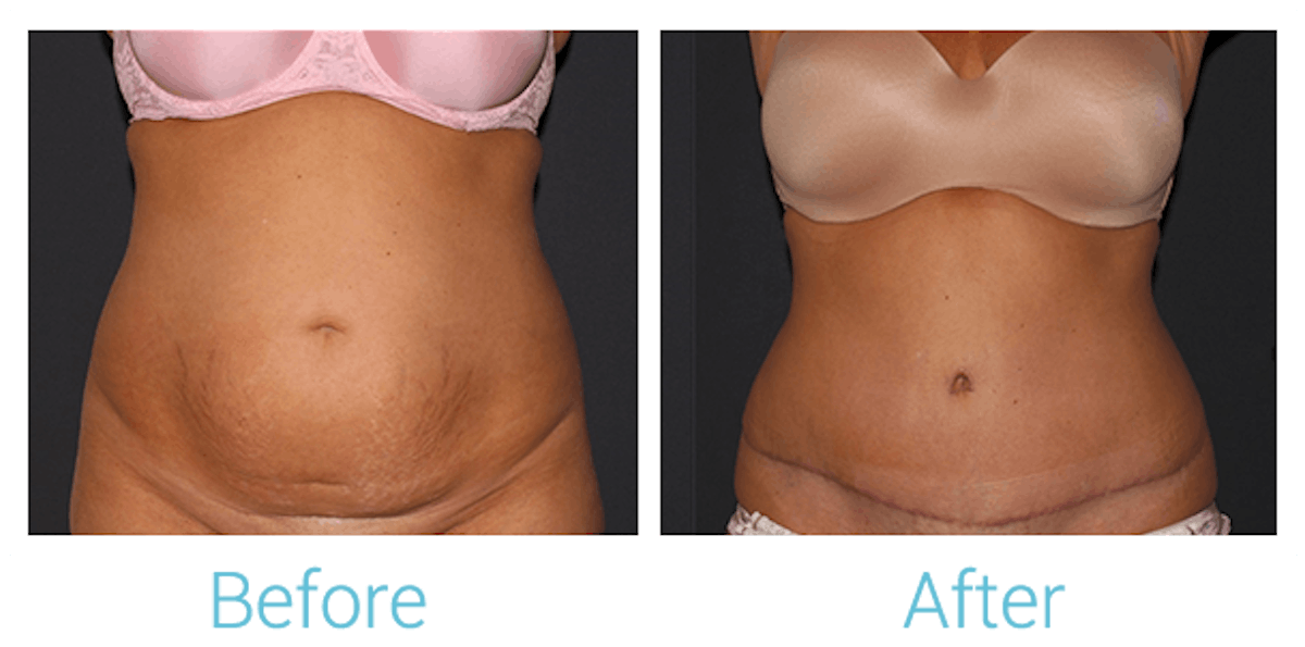 Tummy Tuck Before & After Gallery - Patient 58152087 - Image 1