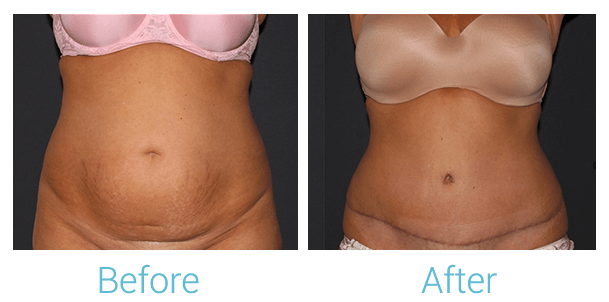 Tummy Tuck Gallery - Patient 58152087 - Image 1
