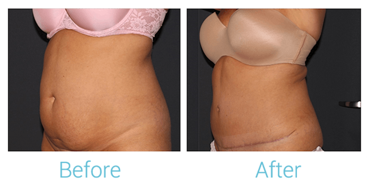 Tummy Tuck Before & After Gallery - Patient 58152087 - Image 2