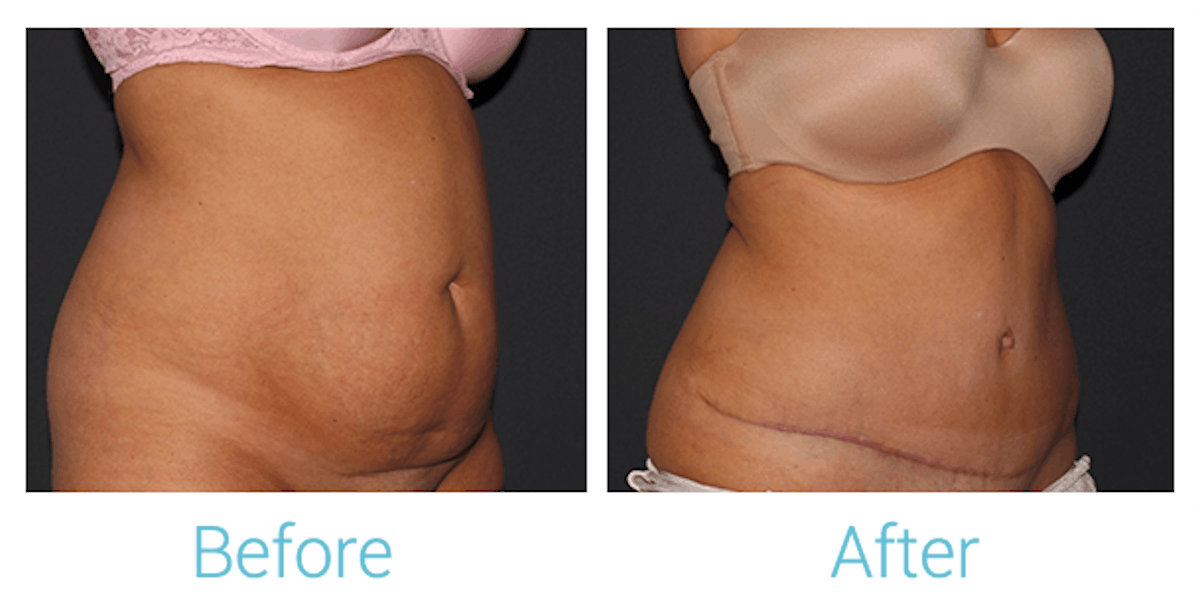 Tummy Tuck Before & After Gallery - Patient 58152087 - Image 3