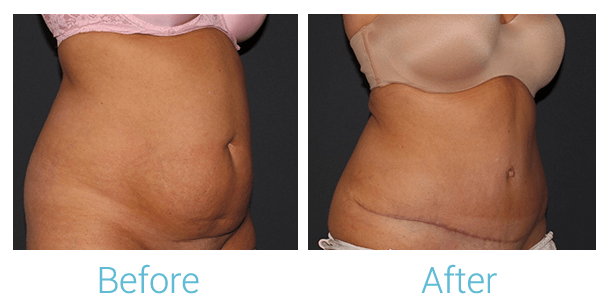 Tummy Tuck Gallery - Patient 58152087 - Image 3