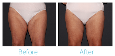 Thigh Lift Before & After Gallery - Patient 58152092 - Image 1