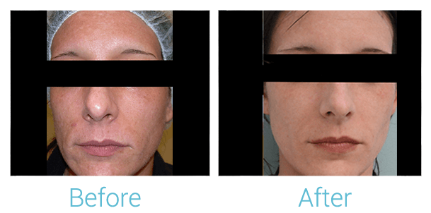 Laser Skin Resurfacing
