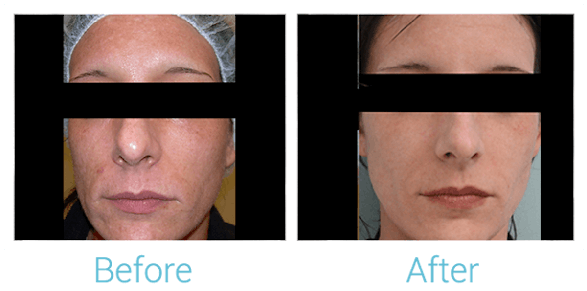 IPL/Resurfx Before & After Gallery - Patient 58152098 - Image 1