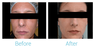 CO2 Laser Skin Resurfacing Before & After Gallery - Patient 58152098 - Image 1