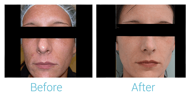 CO2 Laser Skin Resurfacing Before & After Gallery - Patient 58152098 - Image 1