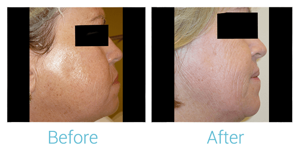 CO2 Laser Skin Resurfacing Before & After Gallery - Patient 58152099 - Image 1