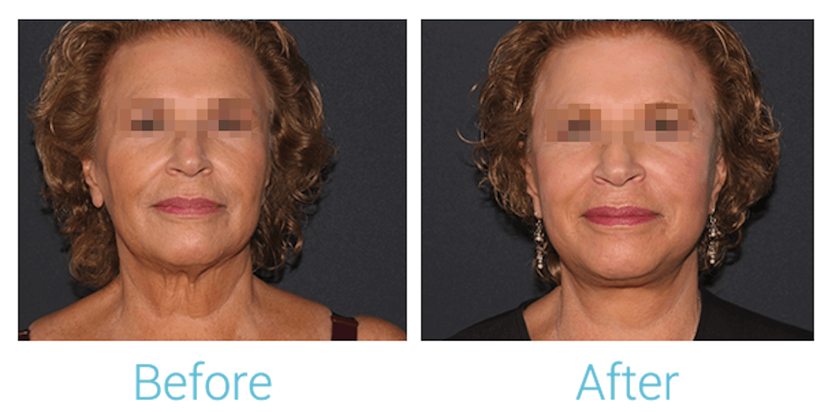 Facelift Before & After Gallery - Patient 58152102 - Image 1