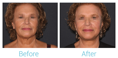 Facelift Before & After Gallery - Patient 58152102 - Image 1