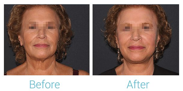 CO2 Laser Skin Resurfacing Before & After Gallery - Patient 58152100 - Image 1