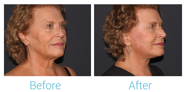 Facelift Before & After Gallery - Patient 58152102 - Image 2