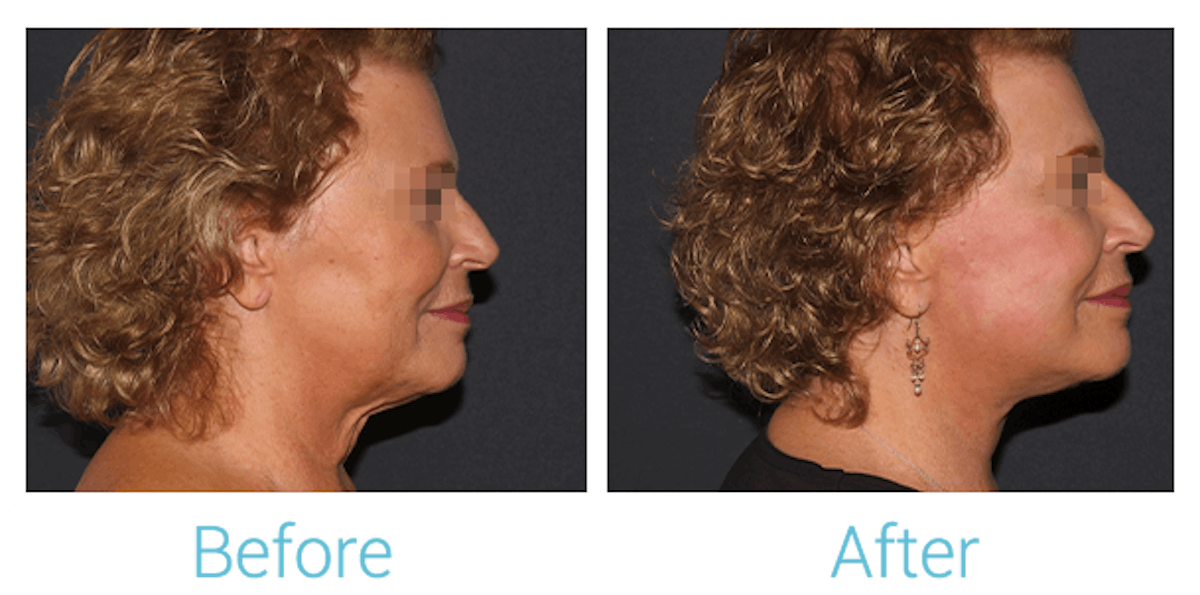 Facelift Before & After Gallery - Patient 58152102 - Image 3