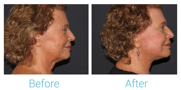 Facelift Before & After Gallery - Patient 58152102 - Image 3