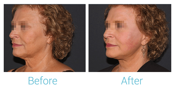 Facelift Before & After Gallery - Patient 58152102 - Image 4