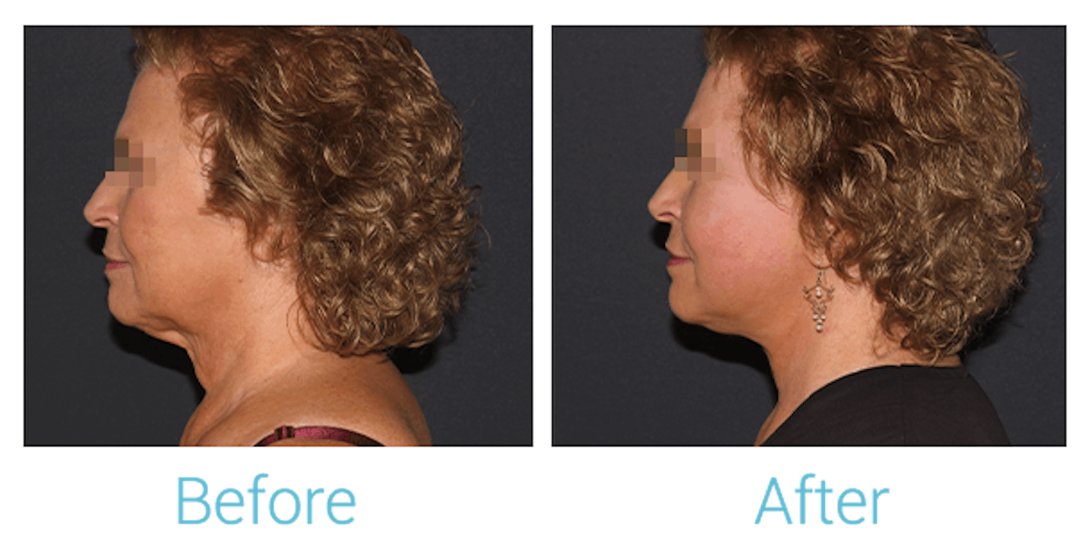 Facelift Before & After Gallery - Patient 58152102 - Image 5