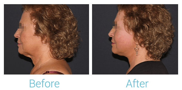 Facelift Before & After Gallery - Patient 58152102 - Image 5